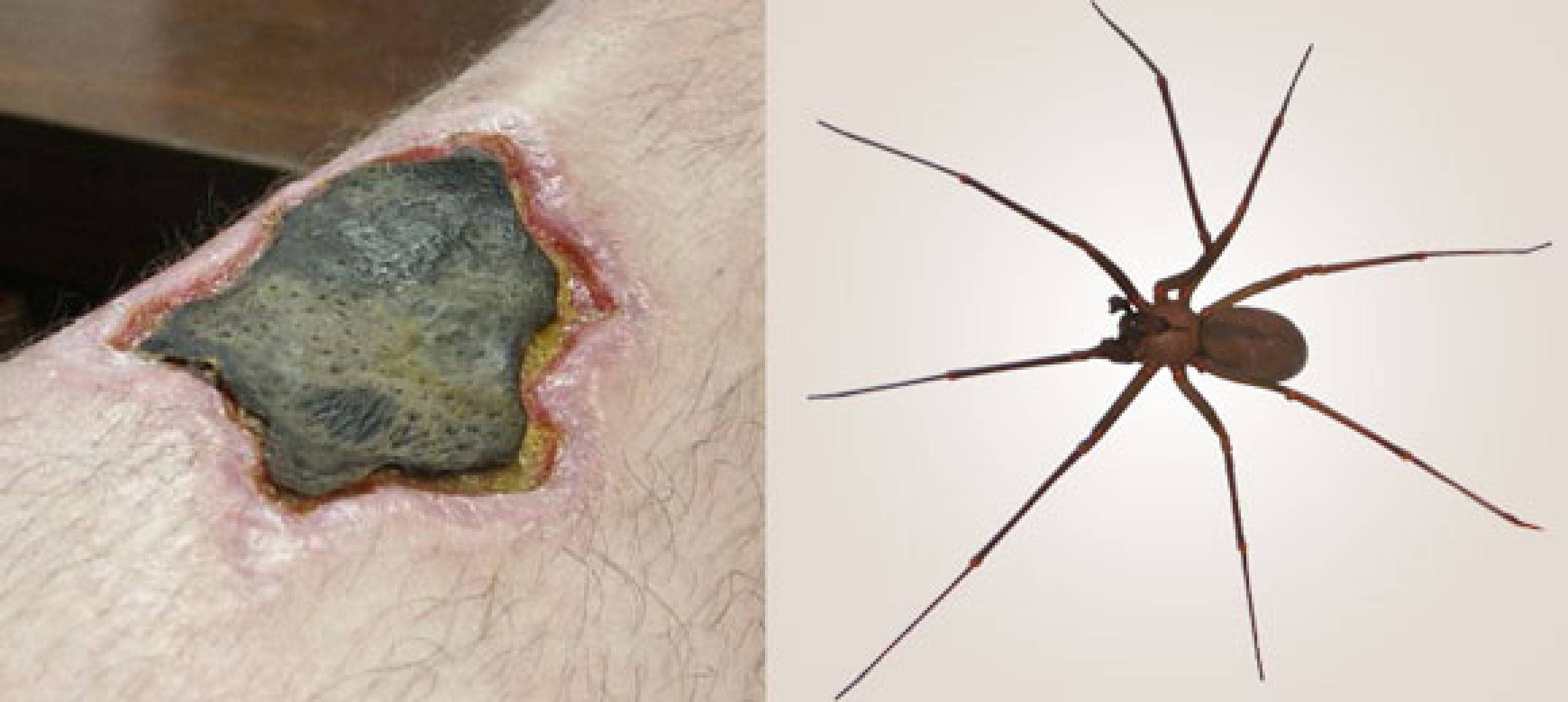 picture of brown recluse bites